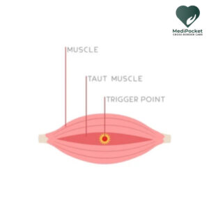 Myofascial pain syndrome- trigger point