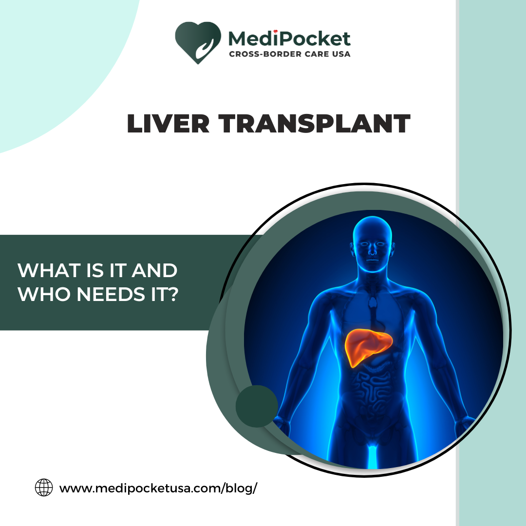 Liver Transplant – What is it and Who needs it? – MediPocket USA