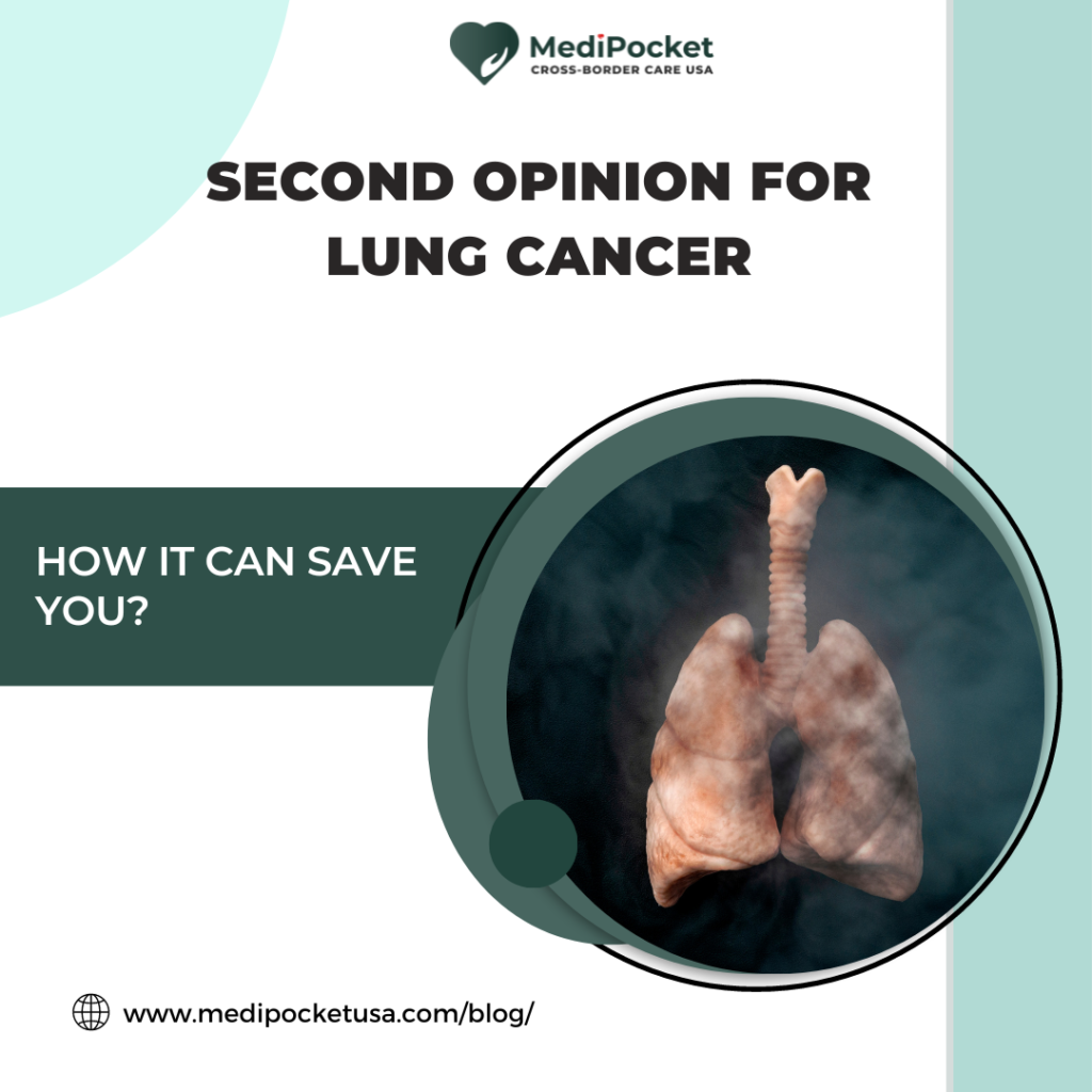Lung cancer - The impact of Second Opinion on Lung Cancer patient
