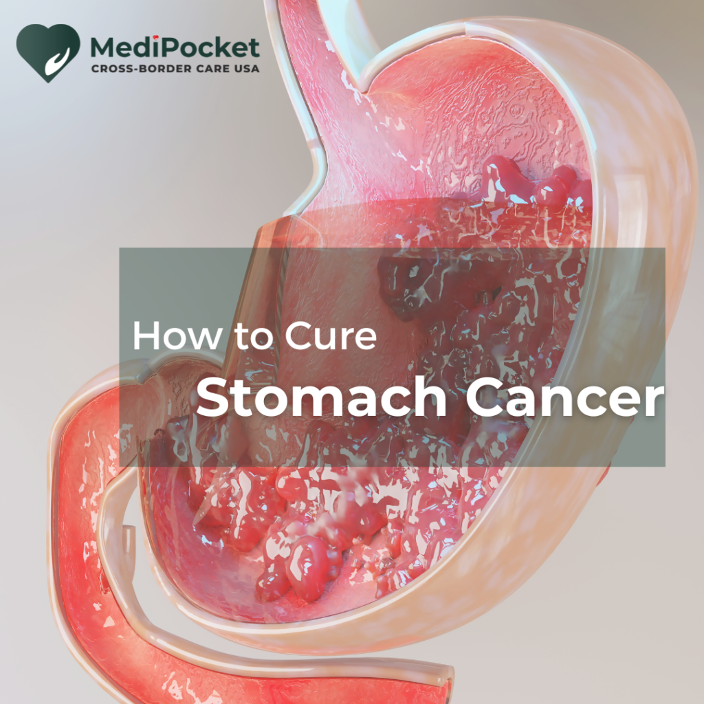 Stomach Cancer and how to cure it?