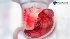Stomach Cancer and its cure