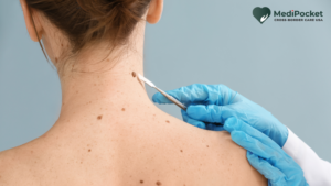 Skin Cancer and treatment