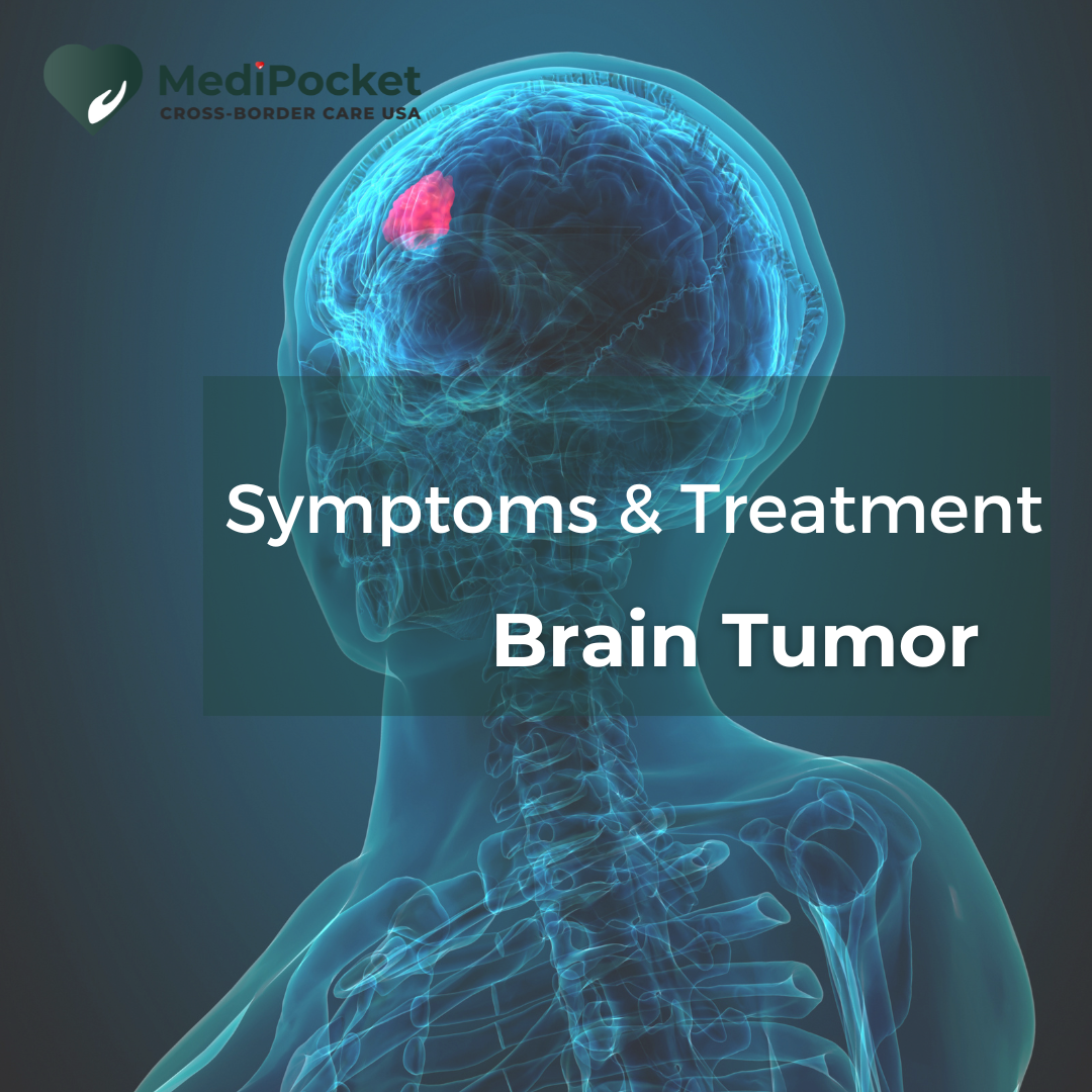 Brain Tumor – Symptoms and Treatment