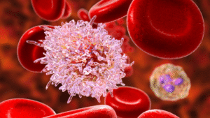 Blood cancer (lLeukemia)