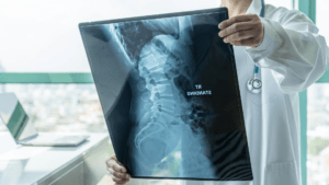Spinal Muscular Atrophy